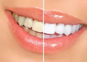 A split-screen before and after close-up of a person's smile, showing discolored yellow teeth on the left and bright white teeth on the right.